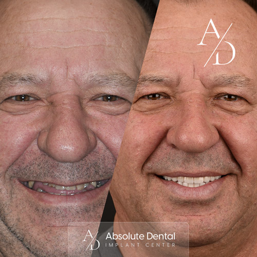 dental-implants-20